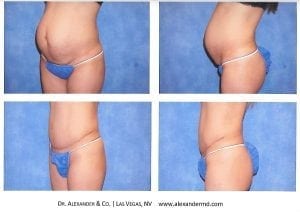 Tummy Tuck before and after photos show a smoother flatter tummy after surgery