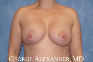 Post Front Breast