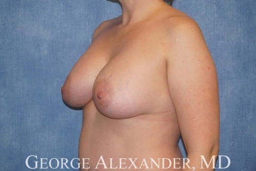 Post Oblique Breast