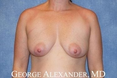 Pre Front Breast