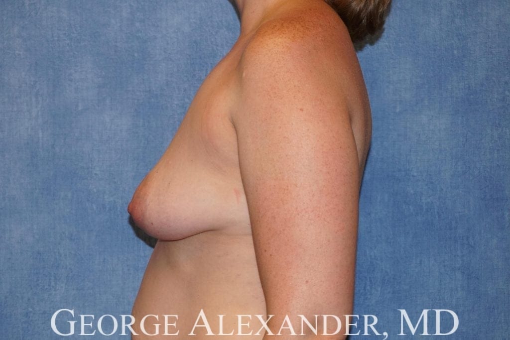 Pre Side Breast