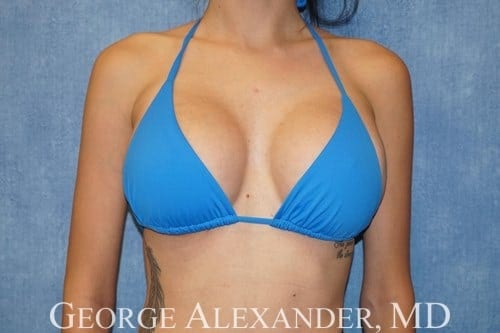 After Front - Breast Implant Exchange