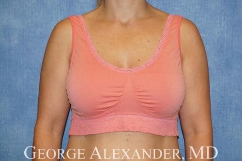 After Front - Breast Augmentation