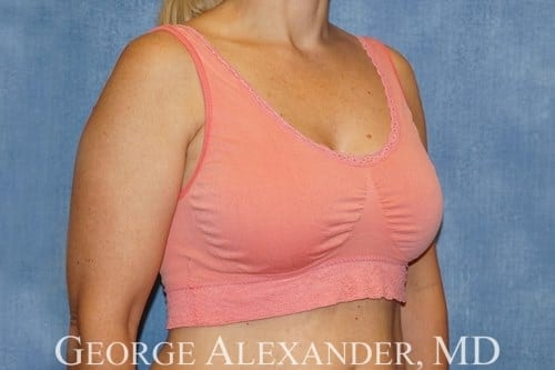 After Oblique - Breast Augmentation