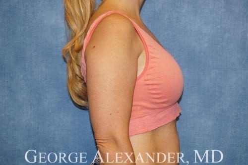 After Side - Breast Augmentation