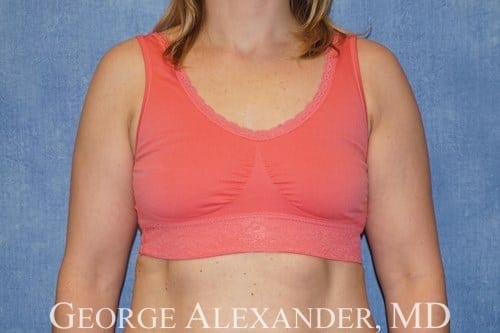 Before Front - Breast Augmentation
