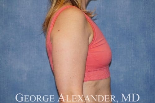 Before Side - Breast Augmentation