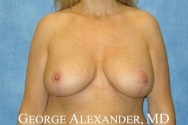 Post Front - Breast Augmentation with Breast Lift