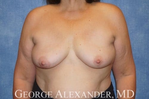 Post Front - Breast Implant Removal
