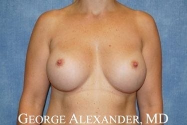 Post Front - Breast Augmentation