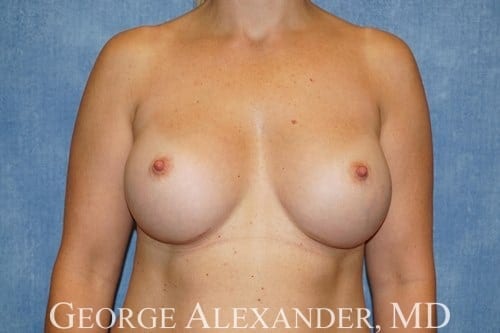 Post Front - Breast Augmentation