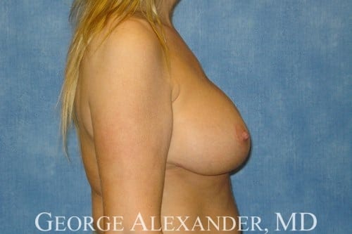 Post Side - Breast Augmentation with Breast Lift