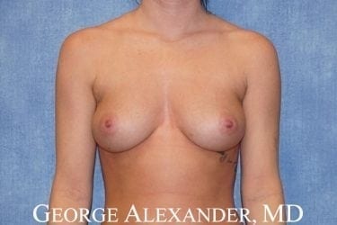 Pre Front - Breast Augmentation