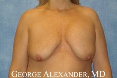 Pre Front - Breast Augmentation with Breast Lift