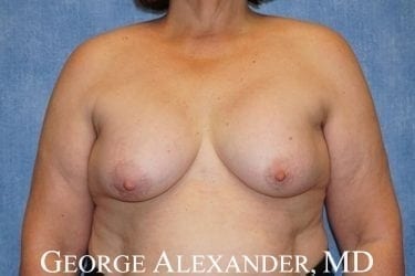 Pre Front - Breast Implant Removal