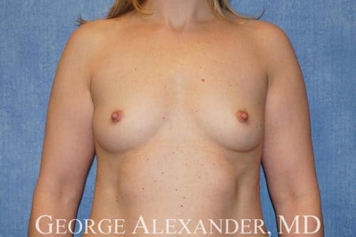 Pre Front - Breast Augmentation