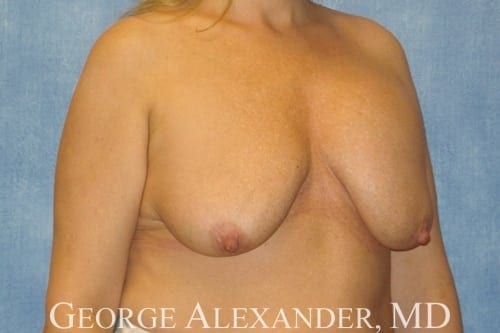 Pre Oblique - Breast Augmentation with Breast Lift