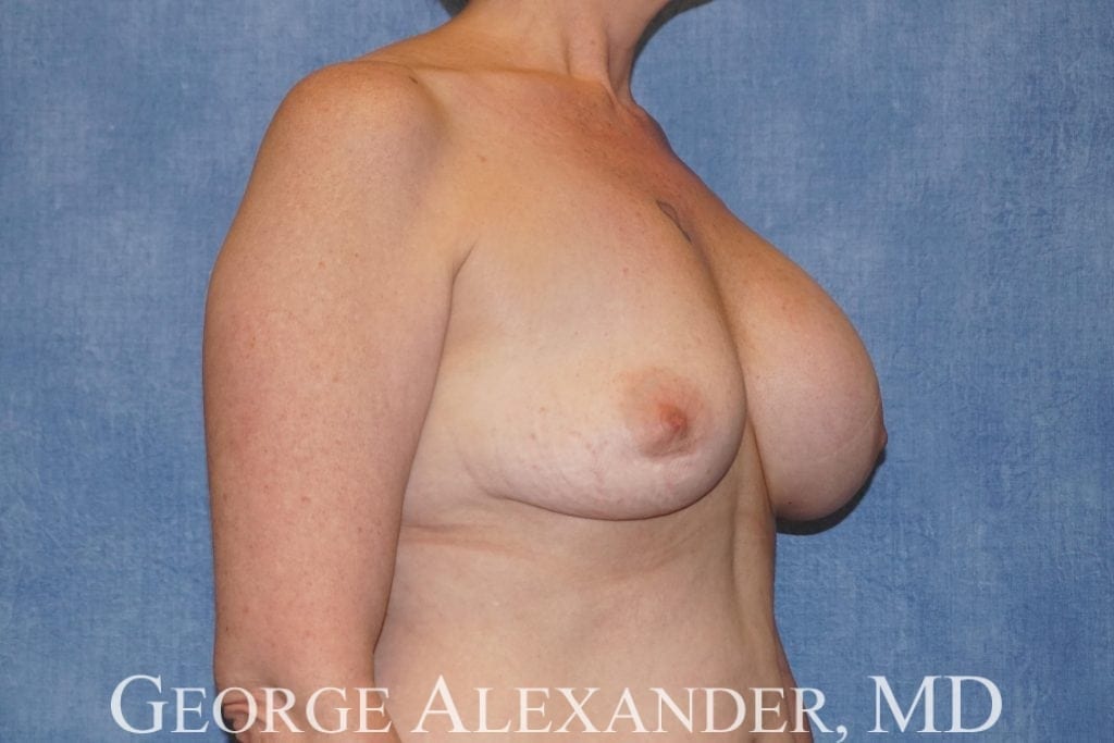 Pre Oblique - Breast Implant Exchange
