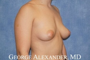 Pre Oblique - Breast Augmentation