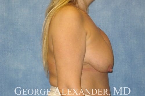 Pre Side - Breast Augmentation with Breast Lift