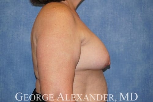Pre Side - Breast Implant Removal