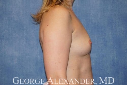 Pre Side - Breast Augmentation