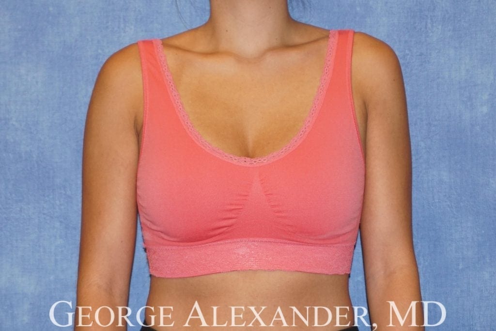 After Front - Breast Implant Exchange