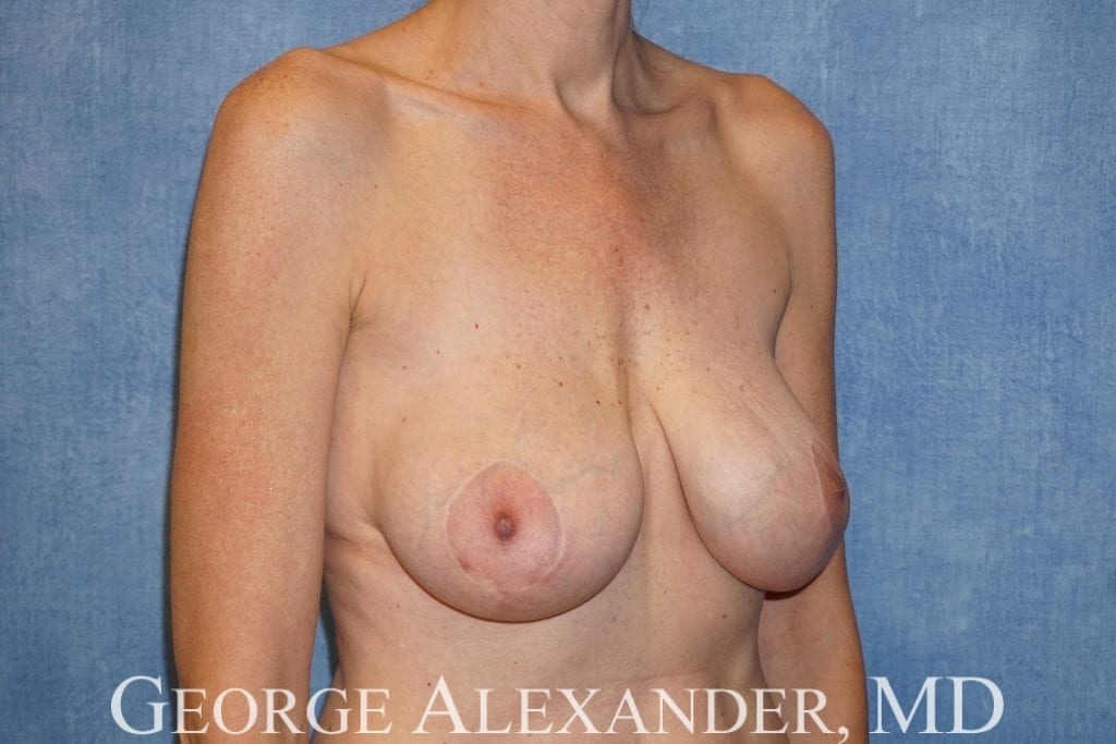 After Oblique - Breast Implant Exchange