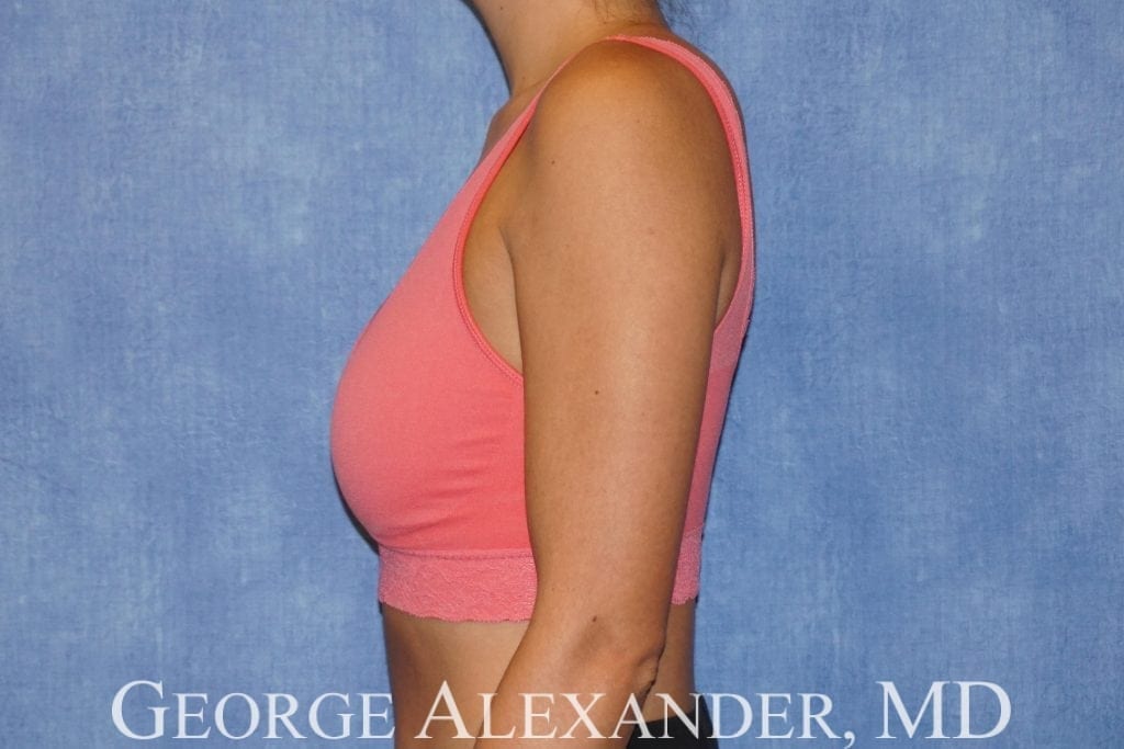 After Side - Breast Implant Exchange