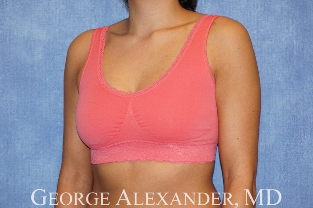 Before Oblique - Breast Implant Exchange