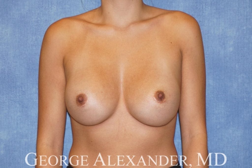 Post Front - Breast Implant Exchange