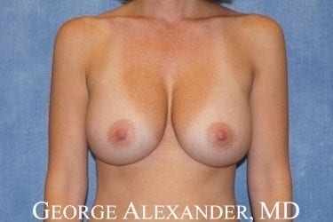 Post Front - Breast Implant Exchange