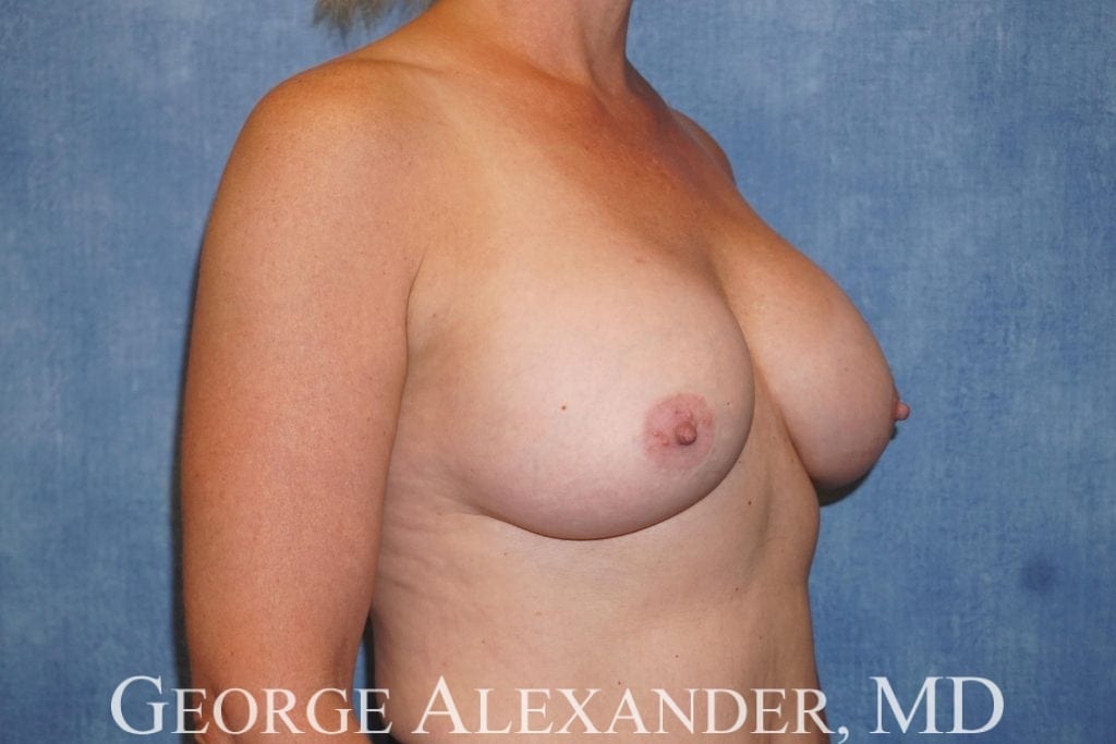 Post Oblique - Breast Implant Exchange