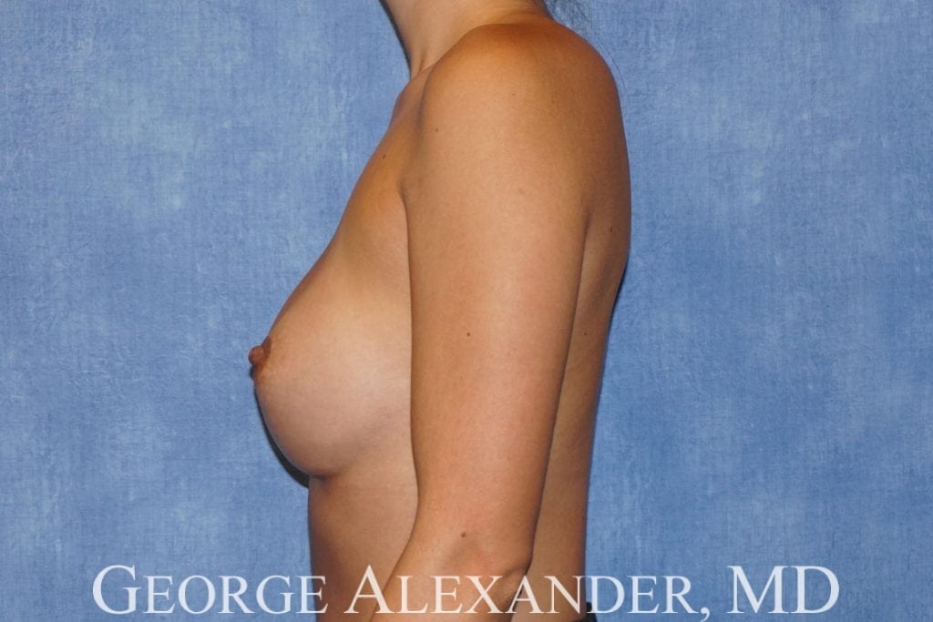 Post Side - Breast Implant Exchange