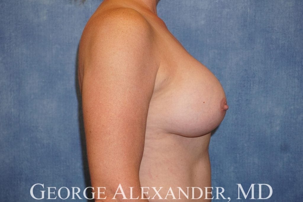 Post Side - Breast Implant Exchange