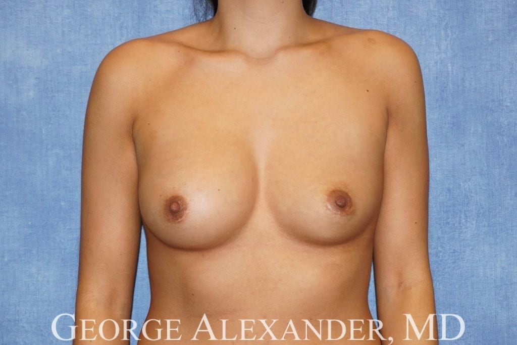 Pre Front - Breast Implant Exchange