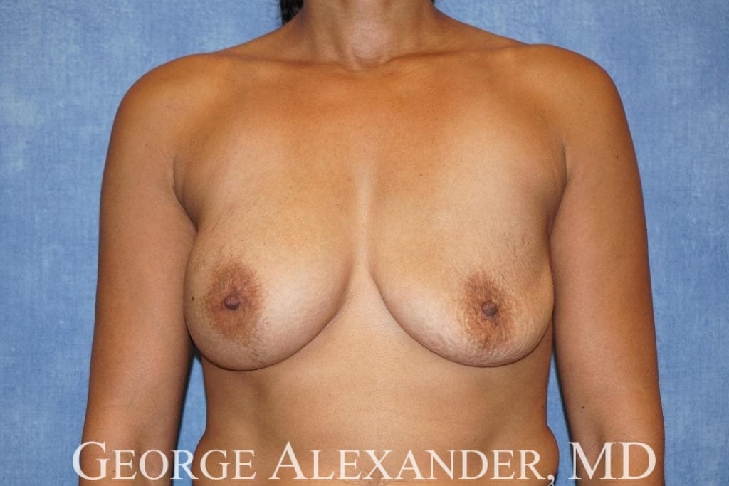 Pre Front - Breast Implant Exchange