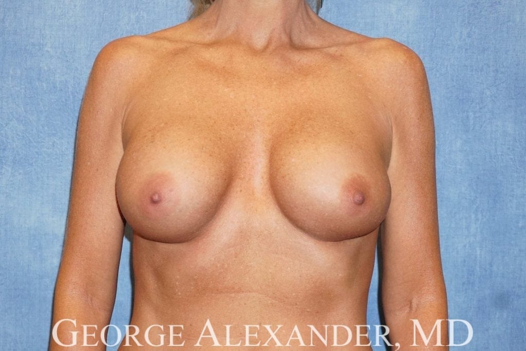 Pre Front - Breast Implant Augmentation