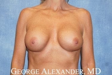 Pre Front - Breast Implant Augmentation