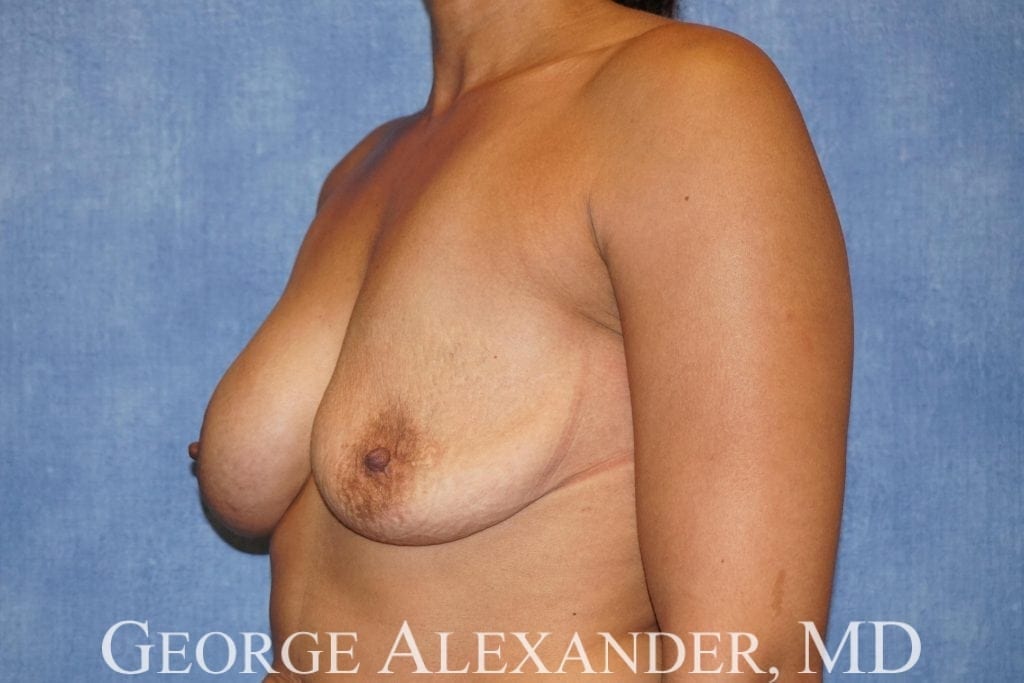 Pre Oblique - Breast Implant Exchange