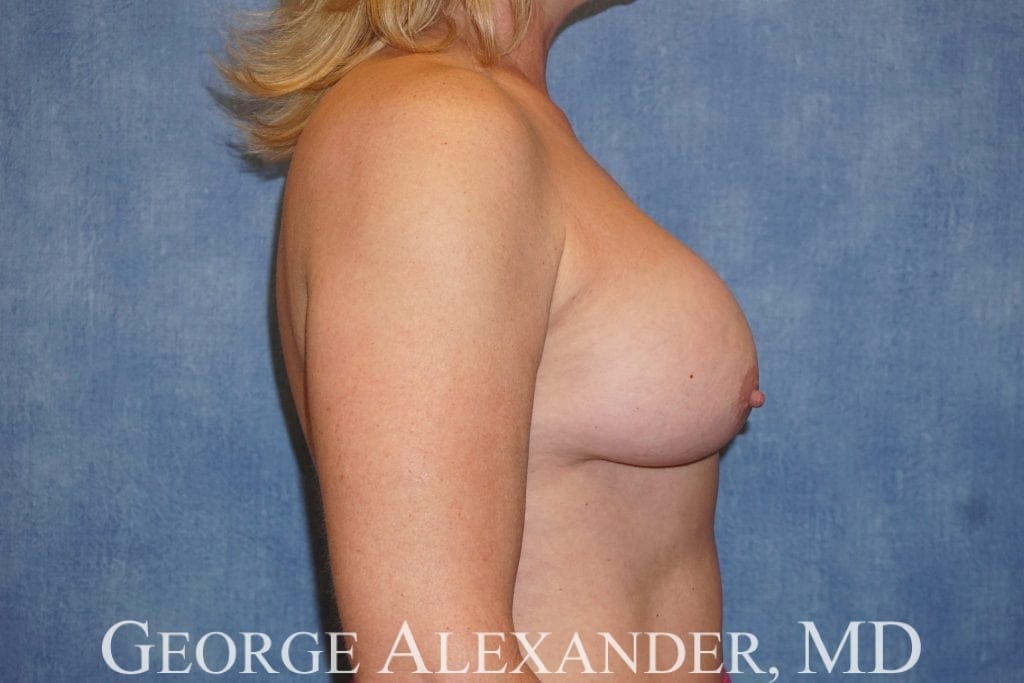 Pre Side - Breast Implant Exchange