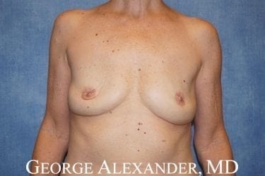 Post Front - Breast Implant Removal