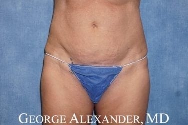 Post Front - Liposuction