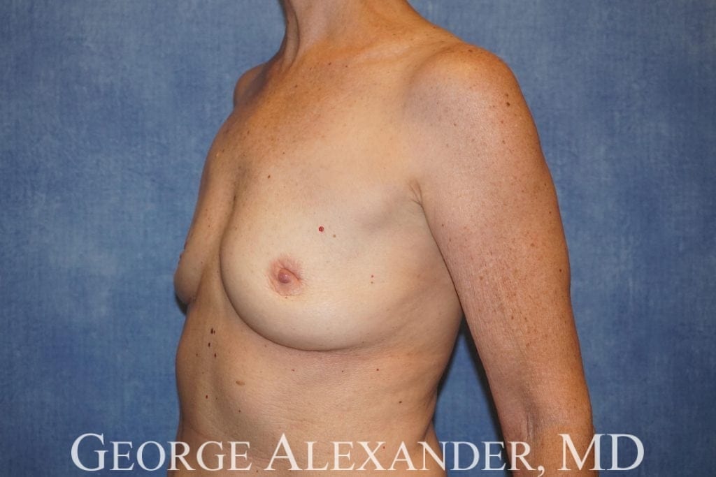 Post Oblique - Breast Implant Removal