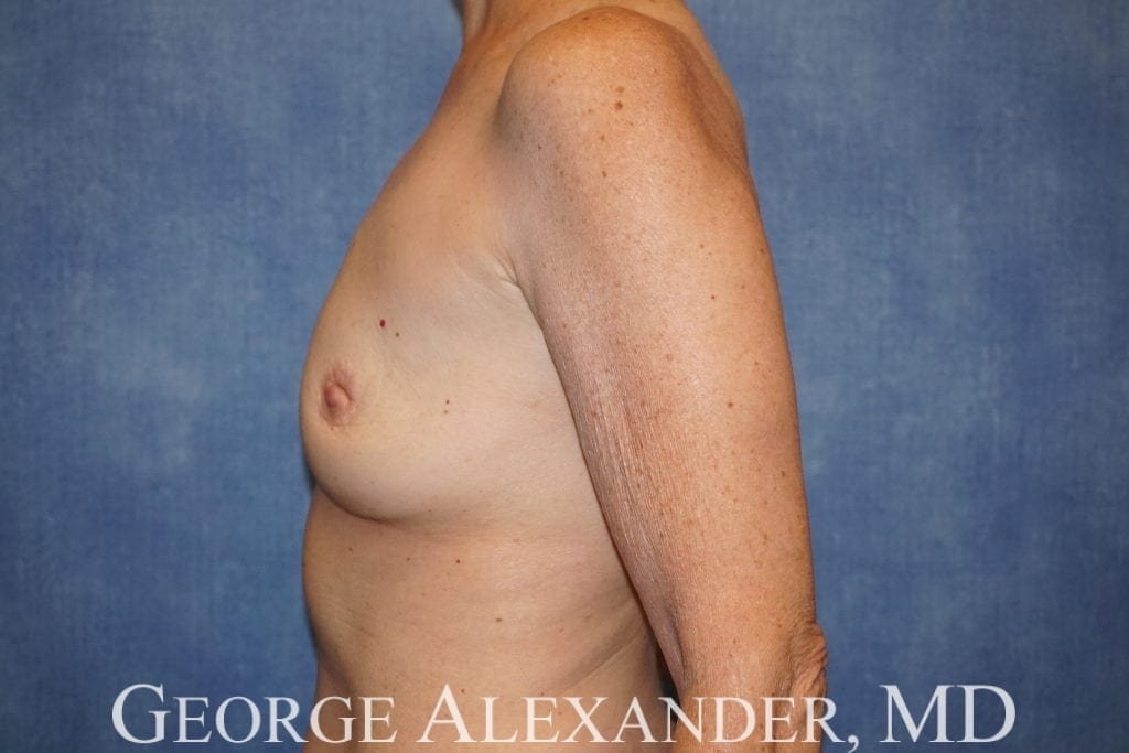 Post Side - Breast Implant Removal