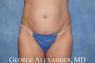 Pre Front - Liposuction