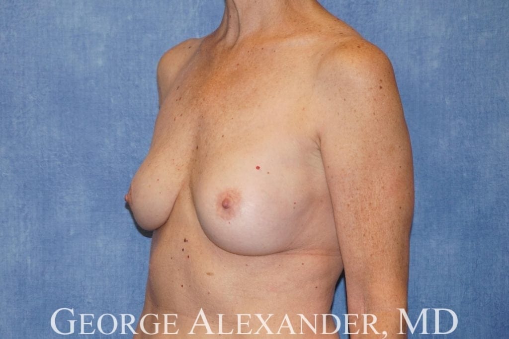 Pre Oblique - Breast Implant Removal