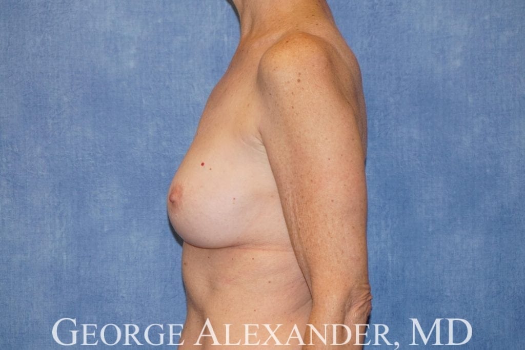 Pre Side - Breast Implant Removal