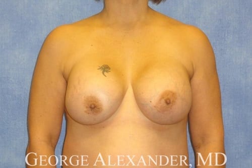 Before  Breast Implant Exchange 3
