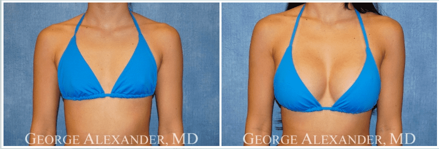 Before surgery and After Surgery, Breast Augmentation Patient
